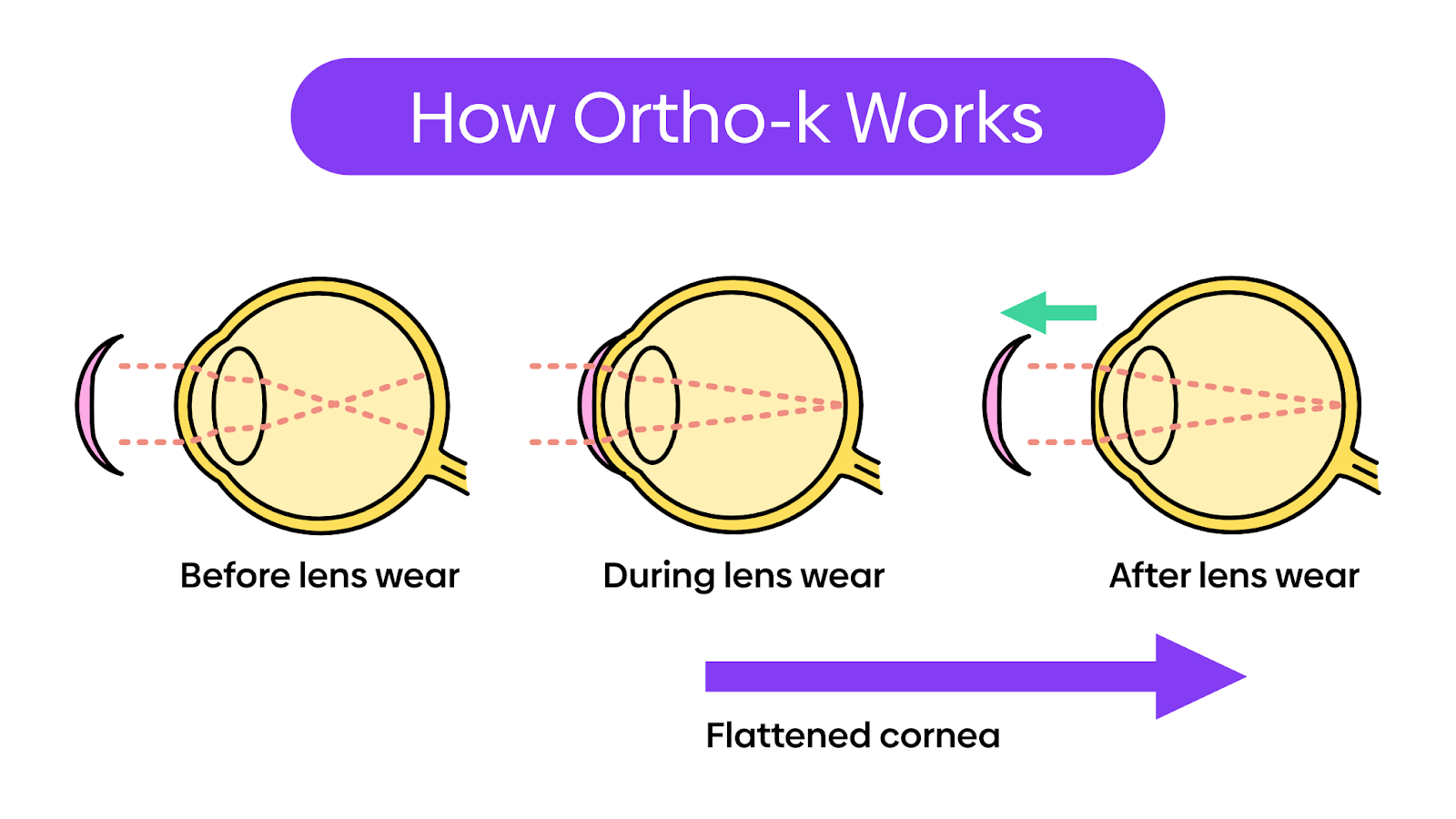 Contact lenses that work while you sleep