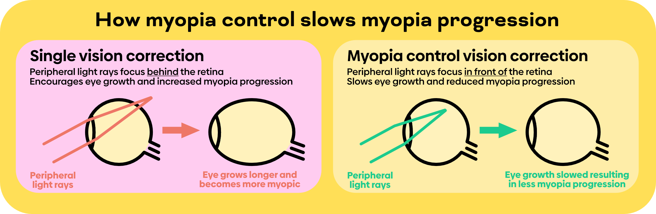 correction of myopia