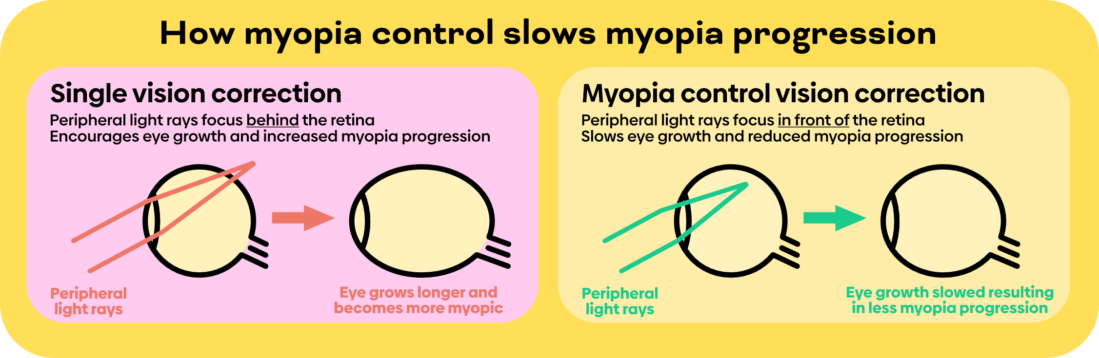 How do myopia control soft contact lenses work? | My Kids Vision