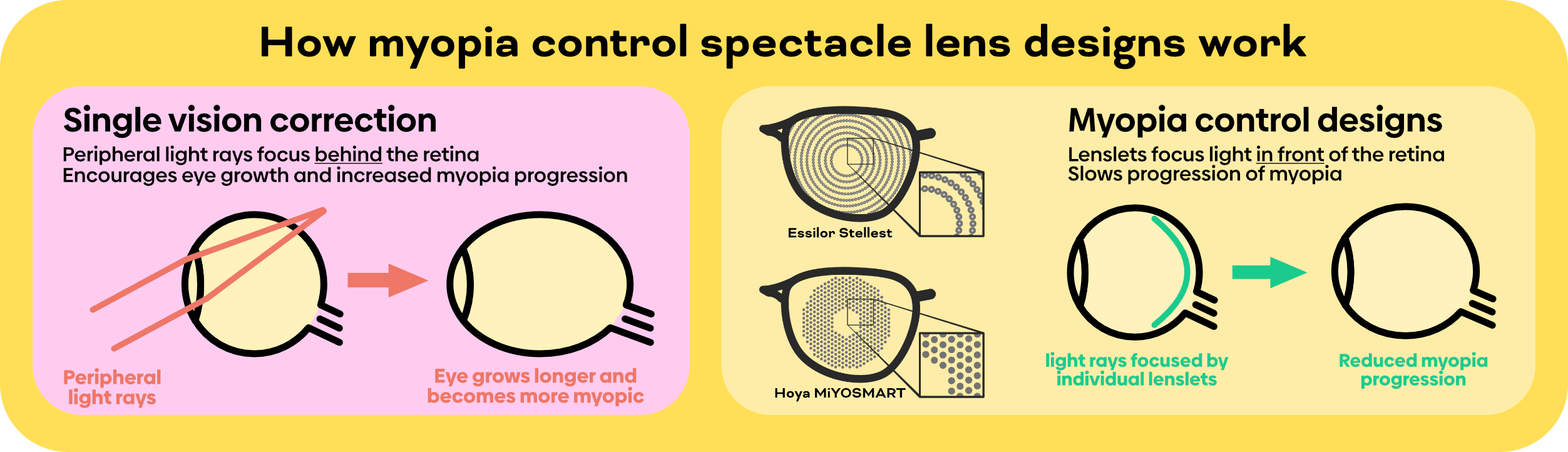 How do cheap glasses correct myopia